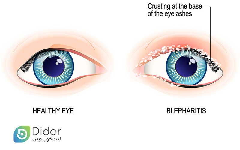 بلفاریت-چشم-چیست-علائم--تشخیص-و-درمان-بلفاریت-کلینیک-چشم-دیدار