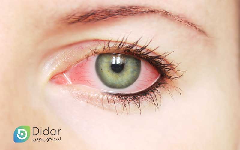 یووئیت-چشم-یا-التهاب-لایه-میانی-چشم-چیست-کلینیک-چشم-دیدار