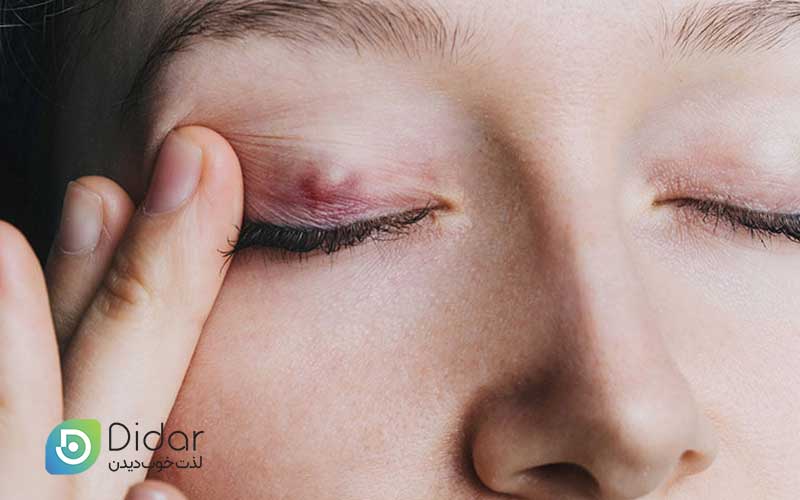 شالازیون چشم چیست؟ تفاوت شالازیون با گل مژه | علل و روش های درمان برآمدگی پلک